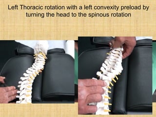 Left Thoracic rotation with a left convexity preload by
turning the head to the spinous rotation
 