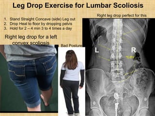 Right leg drop for a left
convex scoliosis
RL
Leg Drop Exercise for Lumbar Scoliosis
1. Stand Straight Concave (side) Leg out
2. Drop Heal to floor by dropping pelvis
3. Hold for 2 – 4 min 3 to 4 times a day
Bad Posture
Right leg drop perfect for this
 