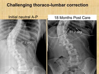 Bend into convexity for goalInitial neutral A-P 18 Months Post Care
Challenging thoraco-lumbar correction
 