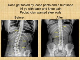 Don’t get fooled by loose pants and a hurt knee
16 yo with back and knee pain
Pediatrician wanted steel rods
Before After
 