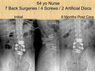 Initial 8 Months Post Care
64 yo Nurse
7 Back Surgeries / 4 Screws / 2 Artificial Discs
 