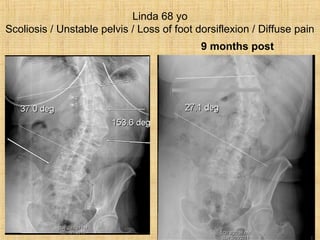 Linda 68 yo
Scoliosis / Unstable pelvis / Loss of foot dorsiflexion / Diffuse pain
9 months post
 