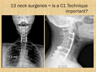 13 neck surgeries = is a C1 Technique
important?
 