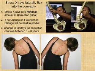 Stress X-rays laterally flex
into the convexity
1. Stress X-rays give minimal
amount of Correction (Goal)
2. If no Change on Flexing then
Change will be hard to predict
3. Change in 90 days full correction
can take between 3 – 8 years
 