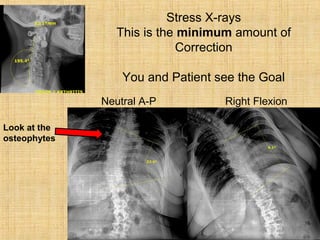 Neutral A-P Right Flexion
Stress X-rays
This is the minimum amount of
Correction
You and Patient see the Goal
Look at the
osteophytes
 