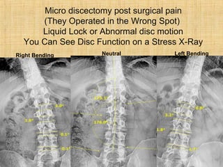 Micro discectomy post surgical pain
(They Operated in the Wrong Spot)
Liquid Lock or Abnormal disc motion
You Can See Disc Function on a Stress X-Ray
Neutral Left BendingRight Bending
 