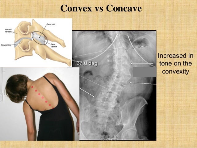convex-and-concave-side-of-scoliosis-qfiz