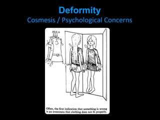 Deformity
Cosmesis / Psychological Concerns
 