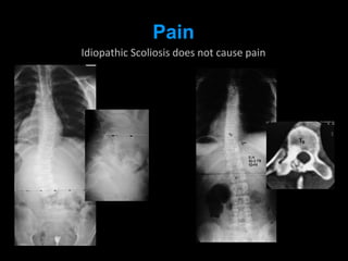 Pain
Idiopathic Scoliosis does not cause pain
 