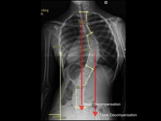 Trunk Decompensation
Head Decompensation
 