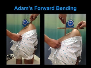 Adam’s Forward Bending
 