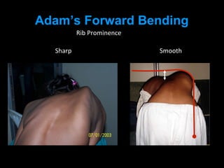 Adam’s Forward Bending
Rib Prominence
Sharp Smooth
 