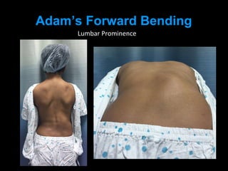 Adam’s Forward Bending
Lumbar Prominence
 