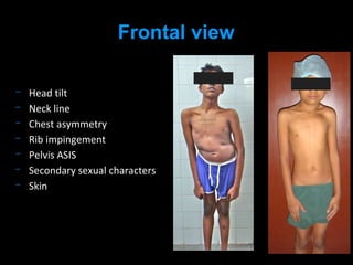 Head tilt
Neck line
Chest asymmetry
Rib impingement
Pelvis ASIS
Secondary sexual characters
Skin
Frontal view
 