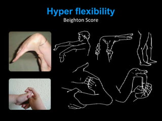 Hyper flexibility
Beighton Score
 