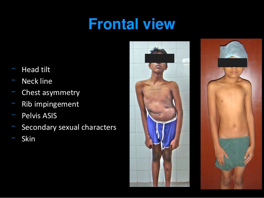 Scoliosis examination