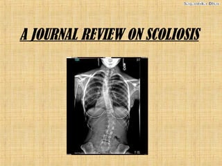 A JOURNAL REVIEW ON SCOLIOSIS
 