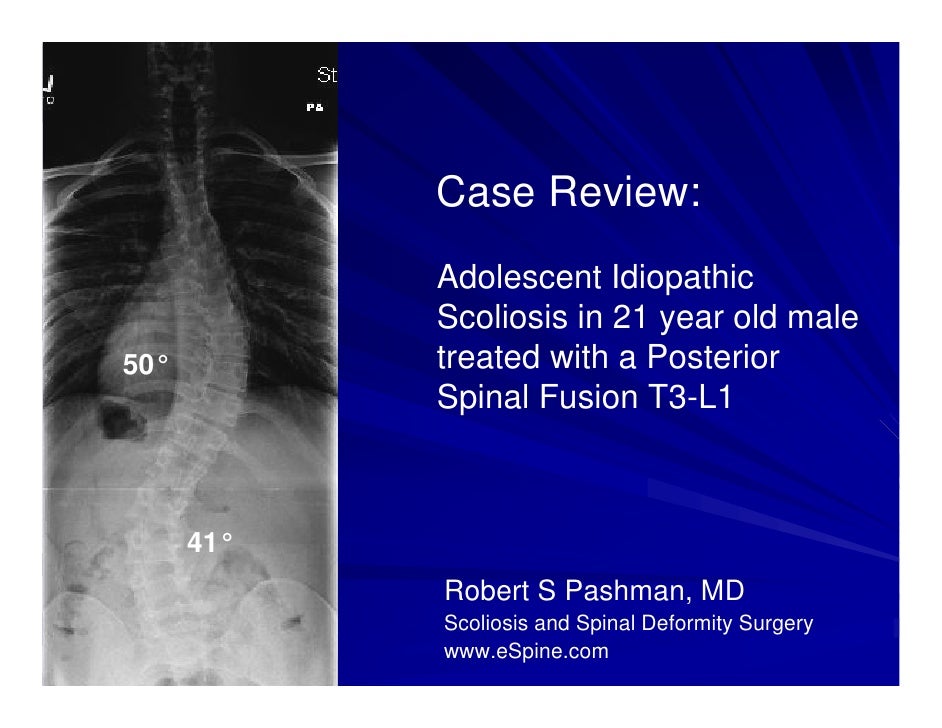 Case Review 9 Adolescent Male With Progressive Scoliosis