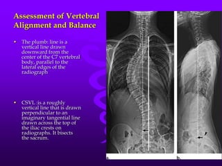 Scoliosis seminar | PPTX