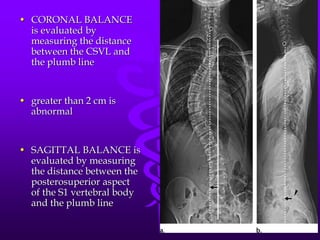 Scoliosis seminar | PPTX