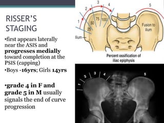 Scoliosis | PPTX