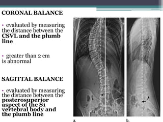 Scoliosis | PPTX