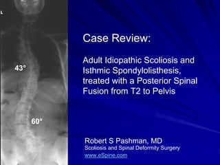 Case Review:
            Adult Idiopathic Scoliosis and
43°         Isthmic Spondylolisthesis,
            treated with a Posterior Spinal
            Fusion from T2 to Pelvis


      60°

            Robert S Pashman, MD
            Scoliosis and Spinal Deformity Surgery
            www.eSpine.com
 