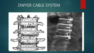 DWYER CABLE SYSTEM
 