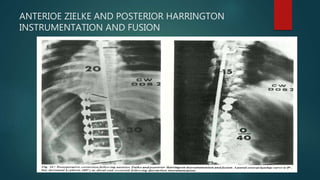 ANTERIOE ZIELKE AND POSTERIOR HARRINGTON
INSTRUMENTATION AND FUSION
 