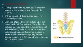  SACROPELVIC FIXATION:
 Many patients with neuromuscular problems
require instrumentation and fusion to the
sacrum.
 O’Brien described three fixation zones for
sacropelvic fixation.
 Examples of zone I fixation include S1 sacral
screws and a McCarthy S-rod. Zone II fixation
includes S2 screws and the Jackson intrasacral
rod technique (see later section on combined
anterior and posterior fusion for scoliosis in
patients with myelomeningocele). Zone III
fixation includes the Galveston L-rod technique
and sacroiliac screws.
 