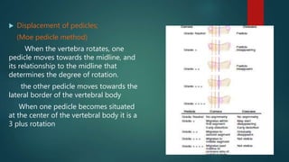  Displacement of pedicles;
(Moe pedicle method)
When the vertebra rotates, one
pedicle moves towards the midline, and
its relationship to the midline that
determines the degree of rotation.
the other pedicle moves towards the
lateral border of the vertebral body
When one pedicle becomes situated
at the center of the vertebral body it is a
3 plus rotation
 