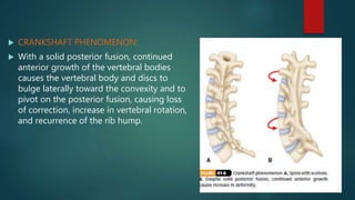  CRANKSHAFT PHENOMENON:
 With a solid posterior fusion, continued
anterior growth of the vertebral bodies
causes the vertebral body and discs to
bulge laterally toward the convexity and to
pivot on the posterior fusion, causing loss
of correction, increase in vertebral rotation,
and recurrence of the rib hump.
 
