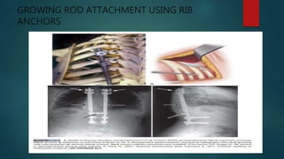 GROWING ROD ATTACHMENT USING RIB
ANCHORS
 