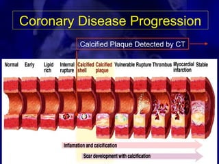 Coronary Disease Progression
Calcified Plaque Detected by CT
 