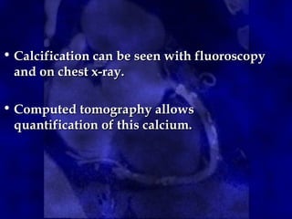• Calcification can be seen with fluoroscopy
Calcification can be seen with fluoroscopy
and on chest x-ray.
and on chest x-ray.
• Computed tomography allows
Computed tomography allows
quantification of this calcium.
quantification of this calcium.
 
