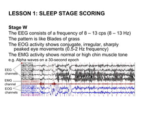 LESSON 1: SLEEP STAGE SCORING

  Stage W
  The EEG consists of a frequency of 8 – 13 cps (8 – 13 Hz)
  The pattern is like Blades of grass
  The EOG activity shows conjugate, irregular, sharply
    peaked eye movements (0.5-2 Hz frequency)
  The EMG activity shows normal or high chin muscle tone
  e.g. Alpha waves on a 30-second epoch

EEG
channels

EMG
channel
EOG
channels
 