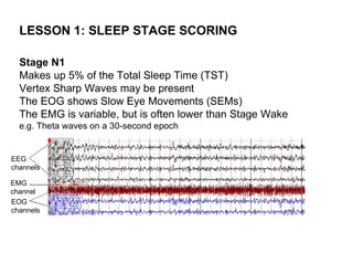 LESSON 1: SLEEP STAGE SCORING

  Stage N1
  Makes up 5% of the Total Sleep Time (TST)
  Vertex Sharp Waves may be present
  The EOG shows Slow Eye Movements (SEMs)
  The EMG is variable, but is often lower than Stage Wake
  e.g. Theta waves on a 30-second epoch


EEG
channels

EMG
channel
EOG
channels
 