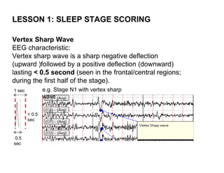 LESSON 1: SLEEP STAGE SCORING

Vertex Sharp Wave
EEG characteristic:
Vertex sharp wave is a sharp negative deflection
(upward )followed by a positive deflection (downward)
lasting < 0.5 second (seen in the frontal/central regions;
during the first half of the stage).
1 sec           e.g. Stage N1 with vertex sharp
                wave


        < 0.5
        sec



 0.5
sec
 