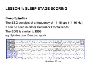 LESSON 1: SLEEP STAGE SCORING

Sleep Spindles
The EEG consists of a frequency of 11-16 cps (11-16 Hz)
It can be seen in either Central or Frontal leads
The EOG is similar to EEG
e.g. Spindles on a 10-second epoch




                                 Spindles= 13 cps
 