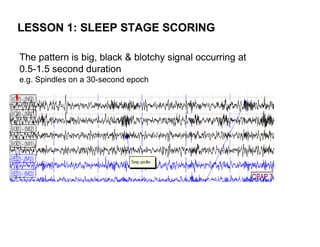 LESSON 1: SLEEP STAGE SCORING

The pattern is big, black & blotchy signal occurring at
0.5-1.5 second duration
e.g. Spindles on a 30-second epoch
 