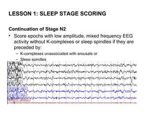 LESSON 1: SLEEP STAGE SCORING

Continuation of Stage N2
• Score epochs with low amplitude, mixed frequency EEG
  activity without K-complexes or sleep spindles if they are
  preceded by:
   – K-complexes unassociated with arousals or
   – Sleep spindles
 