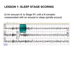 LESSON 1: SLEEP STAGE SCORING

b) An arousal ( to Stage N1 until a K-complex
unassociated with an arousal or sleep spindle occurs)
 