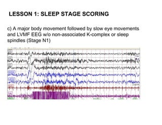 LESSON 1: SLEEP STAGE SCORING

c) A major body movement followed by slow eye movements
and LVMF EEG w/o non-associated K-complex or sleep
spindles (Stage N1)
 