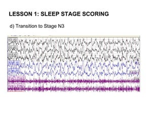 LESSON 1: SLEEP STAGE SCORING

d) Transition to Stage N3
 