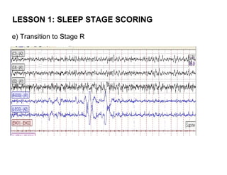 LESSON 1: SLEEP STAGE SCORING

e) Transition to Stage R
 
