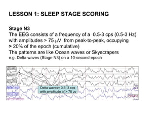 LESSON 1: SLEEP STAGE SCORING

Stage N3
The EEG consists of a frequency of a 0.5-3 cps (0.5-3 Hz)
with amplitudes > 75 V from peak-to-peak, occupying
> 20% of the epoch (cumulative)
The patterns are like Ocean waves or Skyscrapers
e.g. Delta waves (Stage N3) on a 10-second epoch




                Delta waves= 0.5- 3 cps
                with amplitude of > 75 µv
 