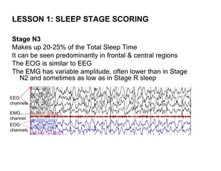 LESSON 1: SLEEP STAGE SCORING

Stage N3
Makes up 20-25% of the Total Sleep Time
It can be seen predominantly in frontal & central regions
The EOG is similar to EEG
The EMG has variable amplitude, often lower than in Stage
    N2 and sometimes as low as in Stage R sleep

EEG
channels

EMG
channel
EOG
channels
 