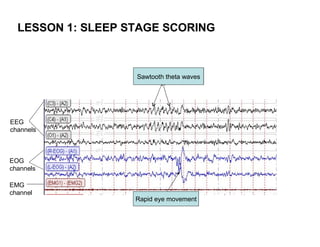 LESSON 1: SLEEP STAGE SCORING



                   Sawtooth theta waves




EEG
channels



EOG
channels

EMG
channel
                   Rapid eye movement
 