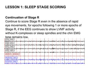 LESSON 1: SLEEP STAGE SCORING

Continuation of Stage R
Continue to score Stage R even in the absence of rapid
eye movements, for epochs following 1 or more epochs of
Stage R, if the EEG continues to show LVMF activity
without K-complexes or sleep spindles and the chin EMG
tone remains low.
 