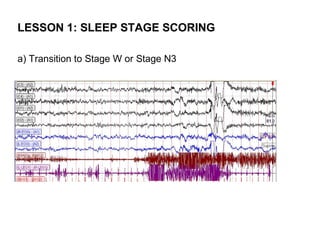 LESSON 1: SLEEP STAGE SCORING

a) Transition to Stage W or Stage N3
 